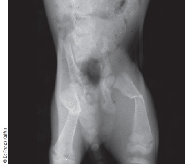 Рентген молодой собаки с вторичным алиментарным гиперпаратиреозом, вызванным недостатком кальция в рационе.